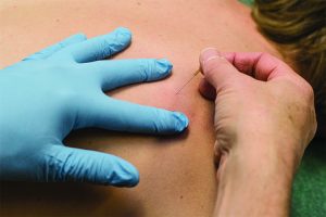 Tirza voert een dry needling behandeling uit